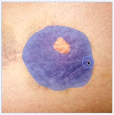 The bruise area marked with a blue brush selection