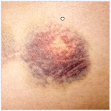 Photo of a bruise on skin